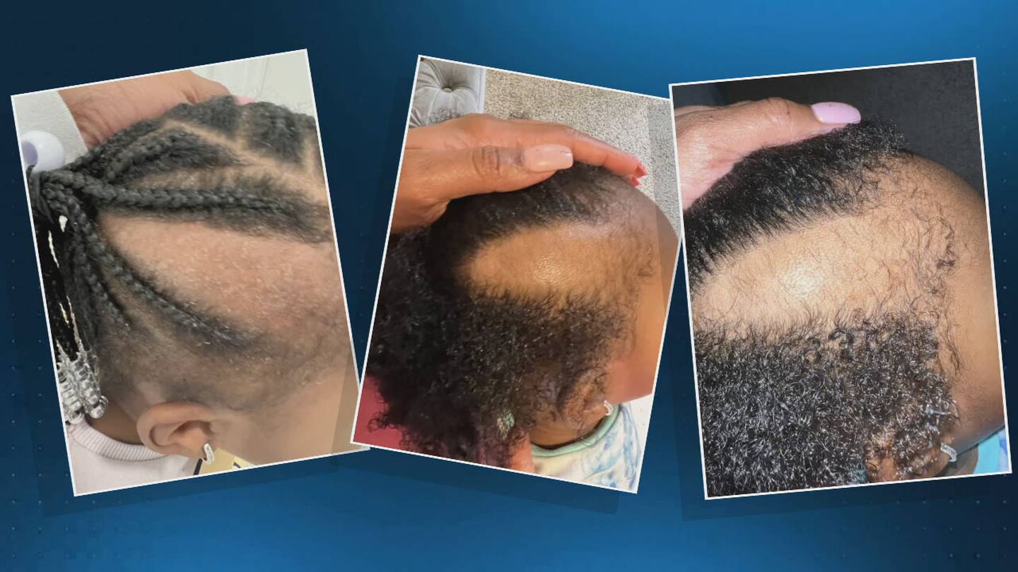 Mother says daughter’s hair was ripped out of her scalp at day care - WSB Atlanta