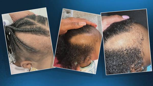 Mother says daughter’s hair was ripped out of her scalp at day care