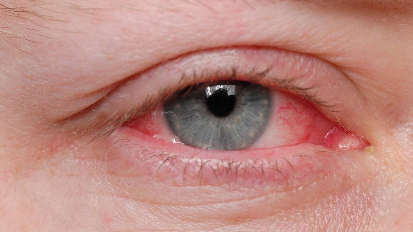 Coronavirus Pink eye could be rare symptom of COVID19 WSBTV Channel 2 Atlanta