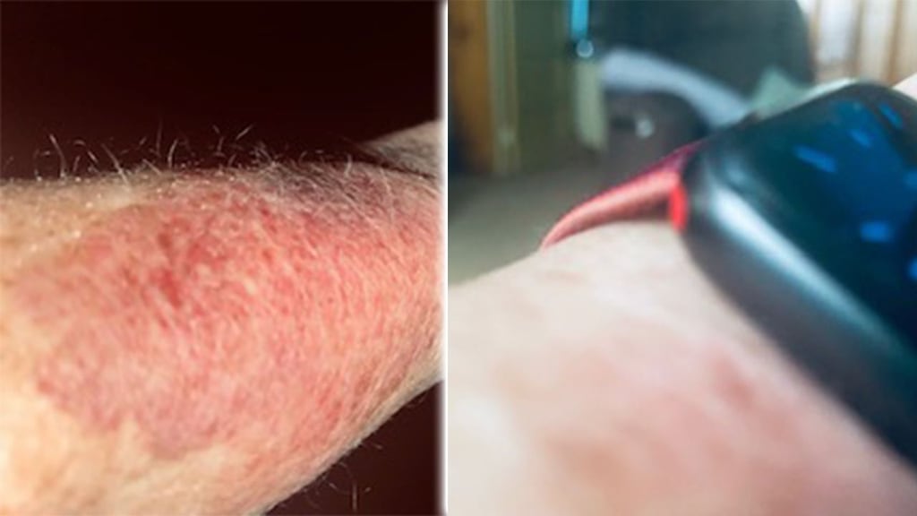 Apple watch skin burn outlet
