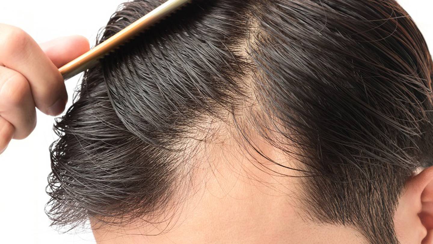 Finasteride vs. Minoxidil: Which men's hair loss treatment is best? –  WSB-TV Channel 2 - Atlanta