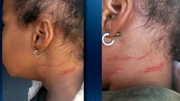 Woman questioning how 3-year-old granddaughter received scratches at metro Atlanta day care