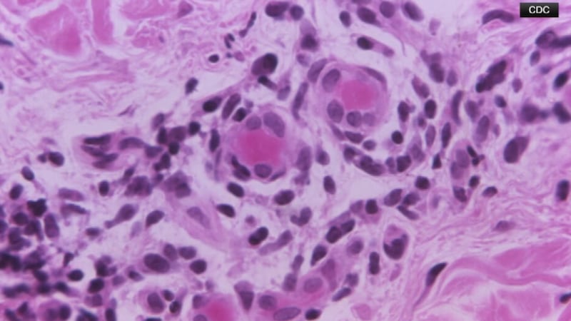 Georgia’s TB case numbers are soaring, worrying doctors